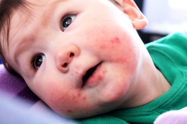 Trẻ sơ sinh và trẻ nhỏ rất dễ gặp căn bệnh truyền nhiễm này