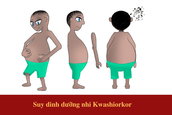Suy dinh dưỡng nhi Kwashiorkor