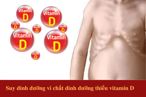 Suy dinh dưỡng vi chất dinh dưỡng thiếu vitamin D