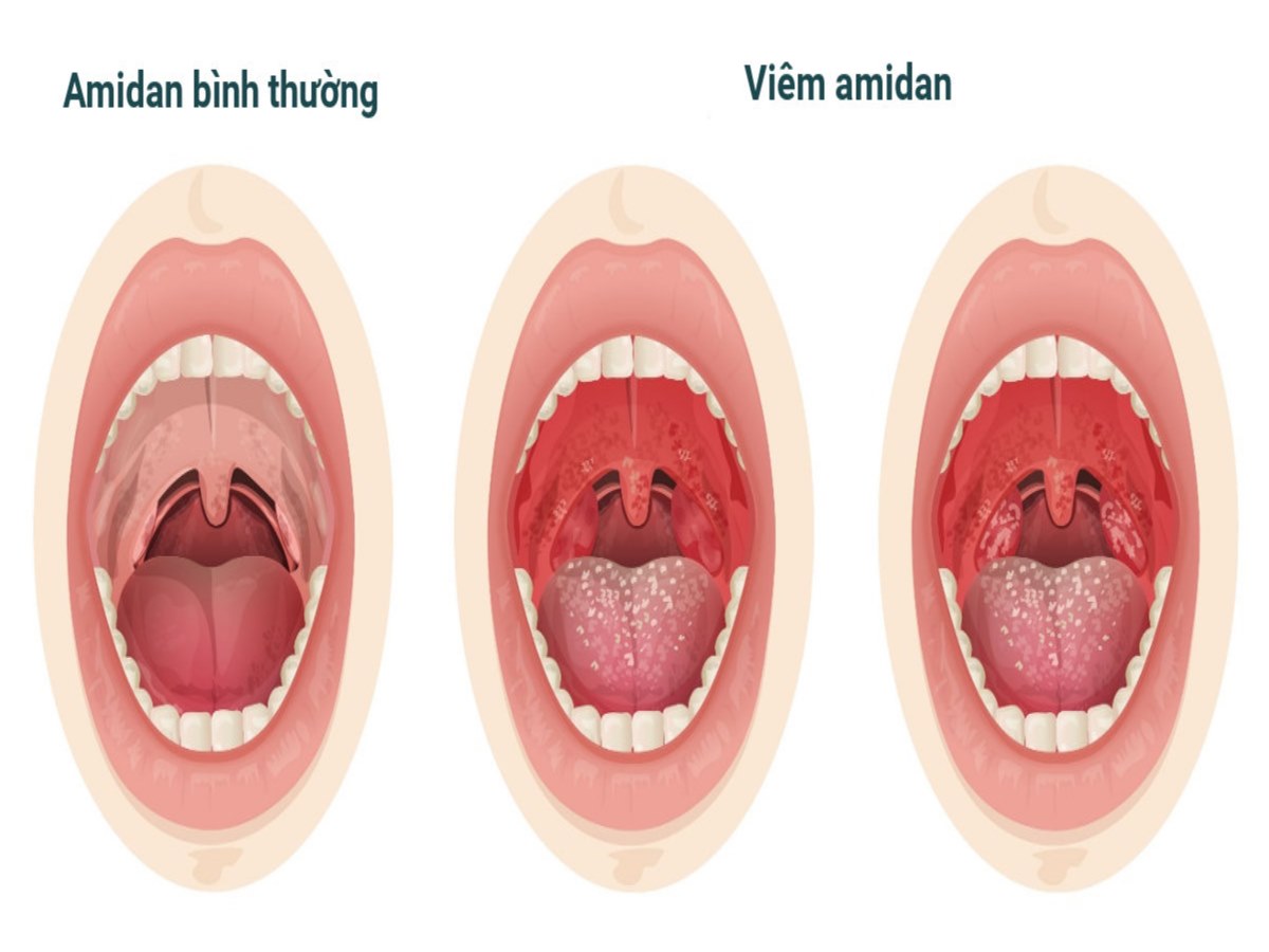 biểu hiện của amidan giống với viêm họng