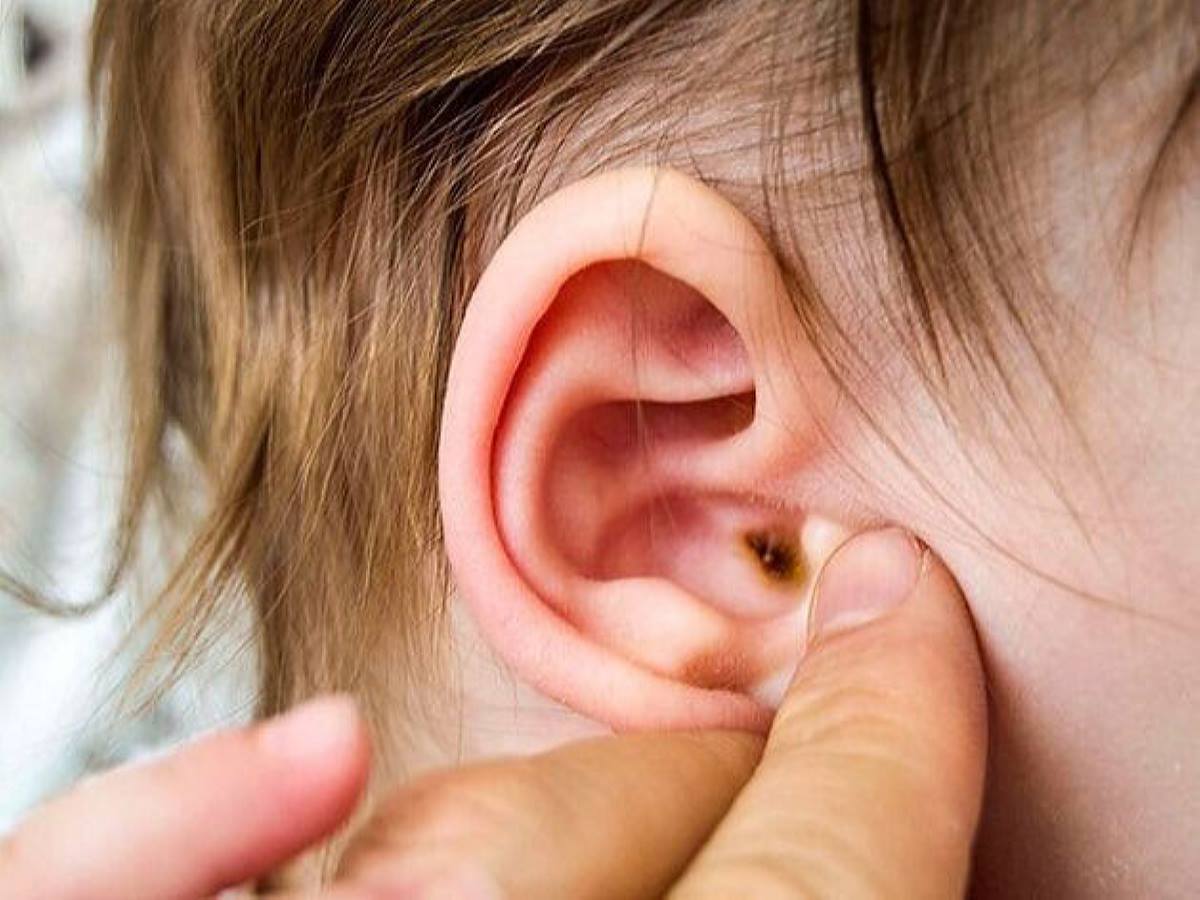 trẻ thường mắc bệnh viêm tai giữa
