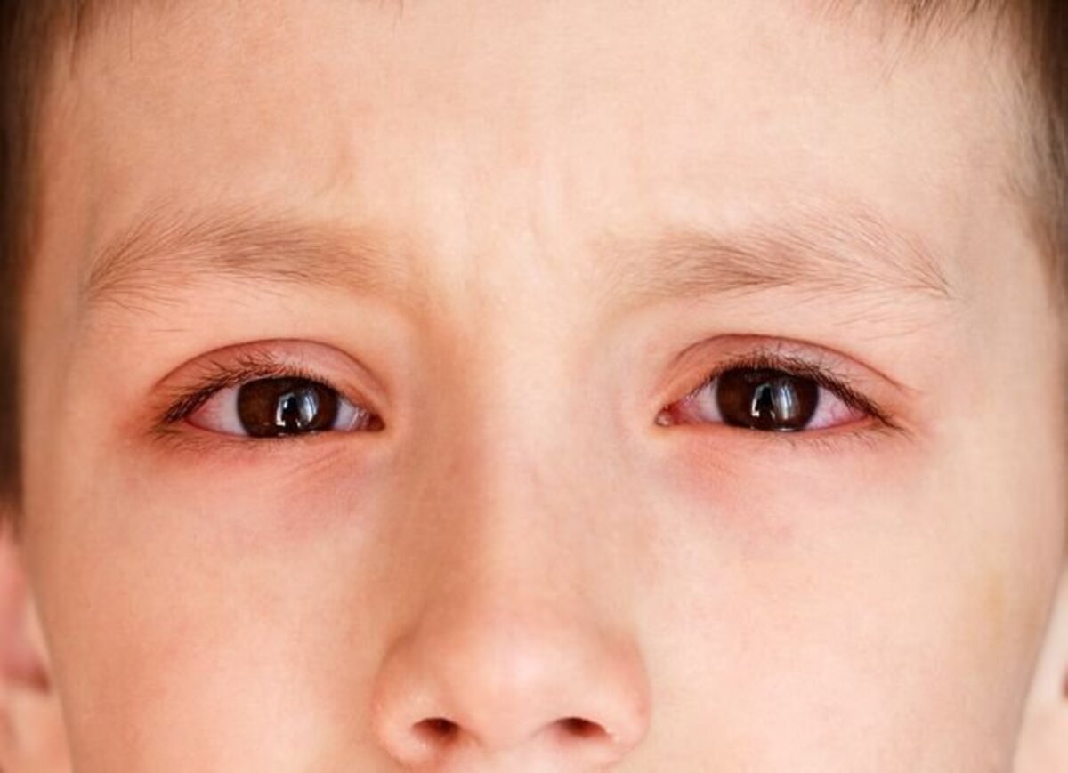 bệnh đau mắt đỏ ở trẻ nhỏ