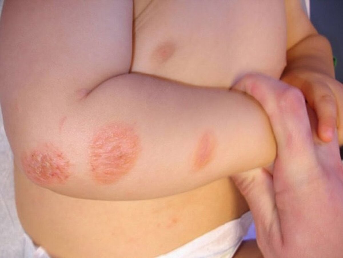bệnh về da thường thấy ở trẻ