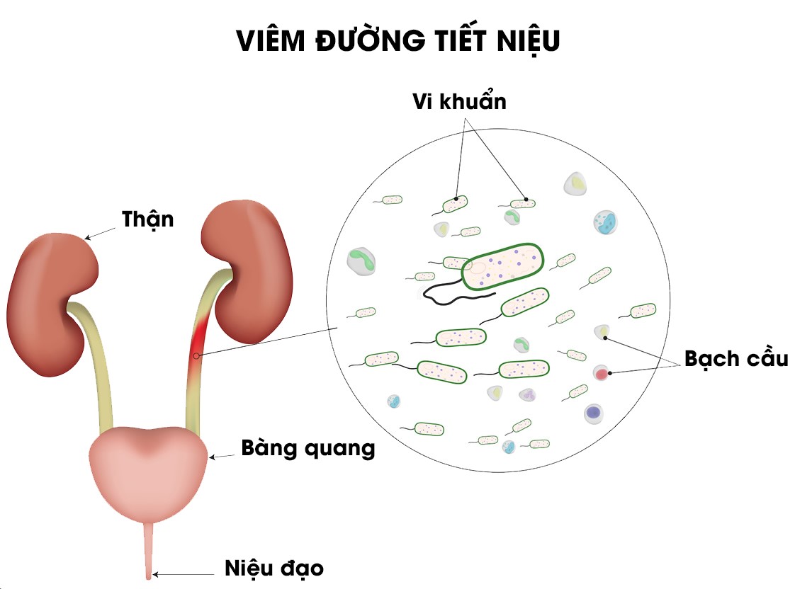 bệnh viêm đường tiết niệu là gì