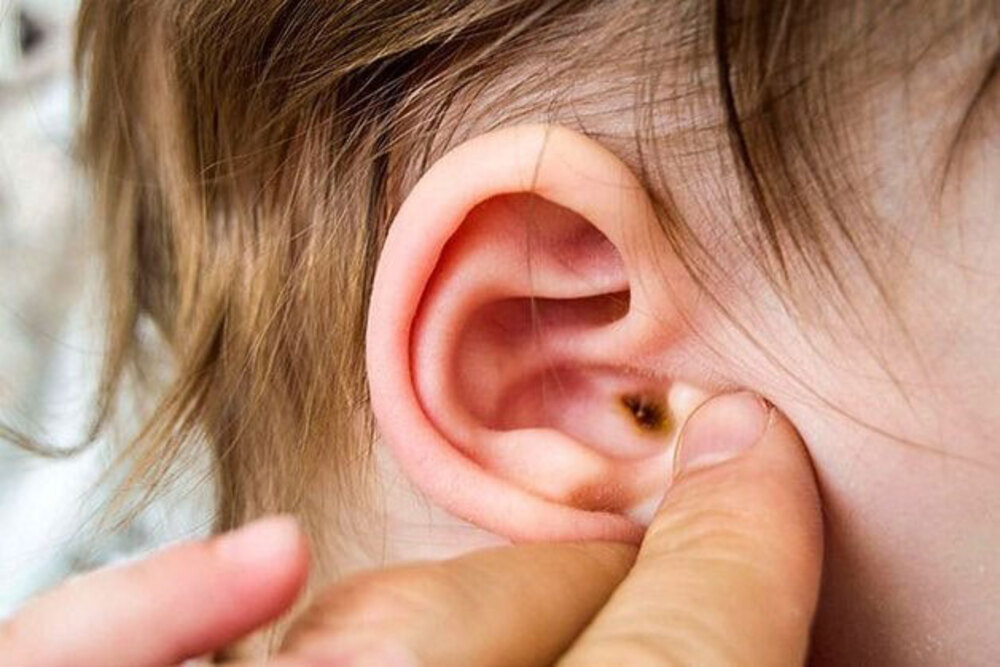bệnh viêm tai thường thấy ở trẻ