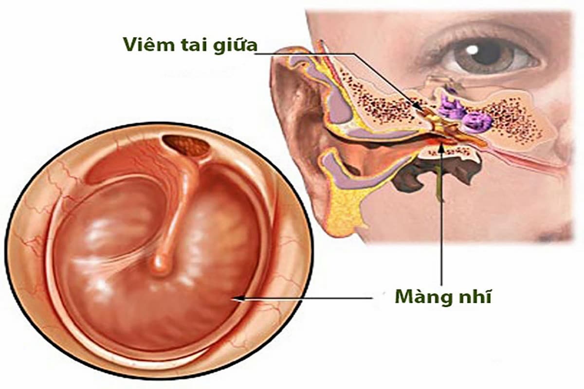 tai trẻ sơ sinh dễ mắc bệnh viêm tai giữa